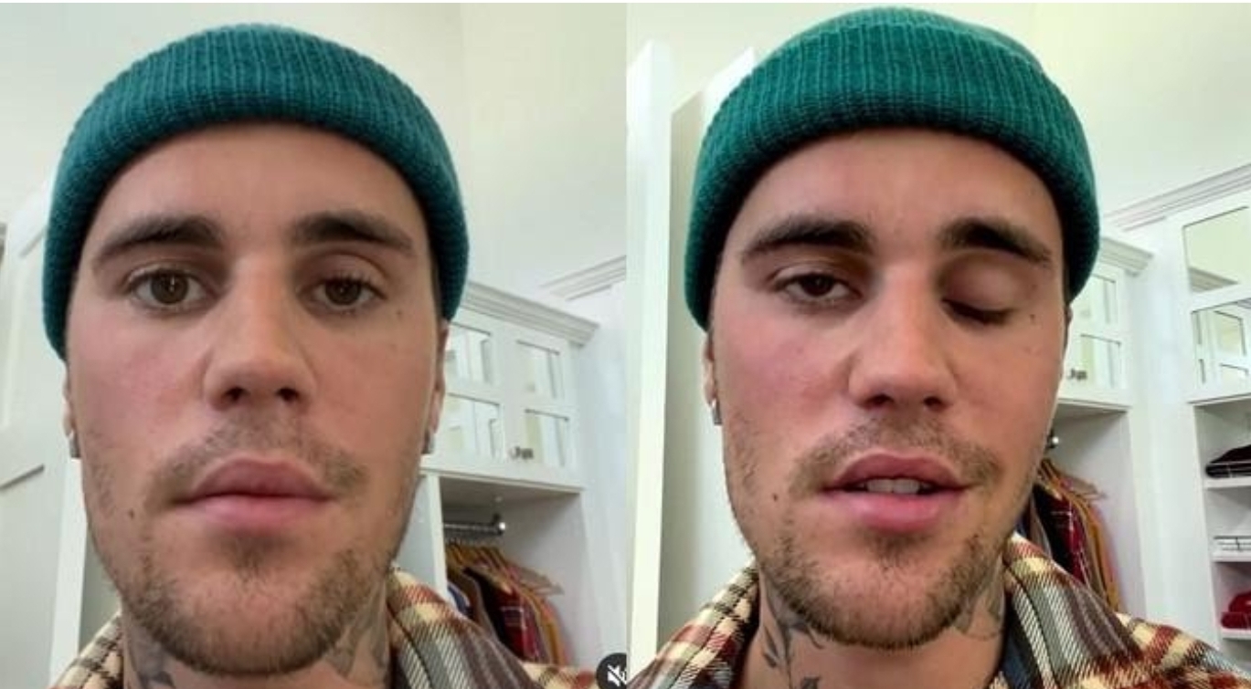 Justin Bieber Ungkap Alami Kelumpuhan Sebagian Wajah, Tur Konser Terpaksa Ditunda