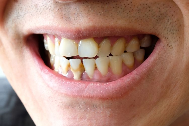 Ini Tips Untuk Menghilangkan Karang Gigi