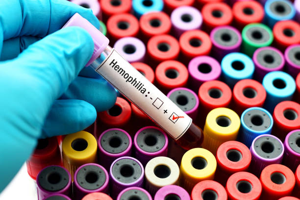 Mengenal Hemofilia, Penyakit Darah Susah Beku dan Penanganannya